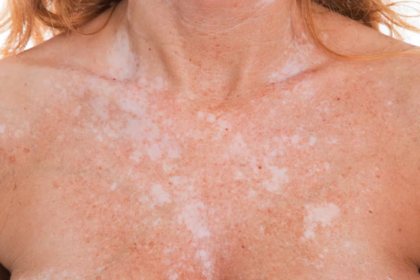 Da Mundial del Vitiligo, mucho ms que un trastorno en la pigmentacin de la piel